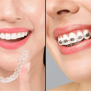 braces and alingers