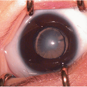 cataract-eye