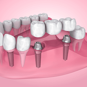 Dental implants